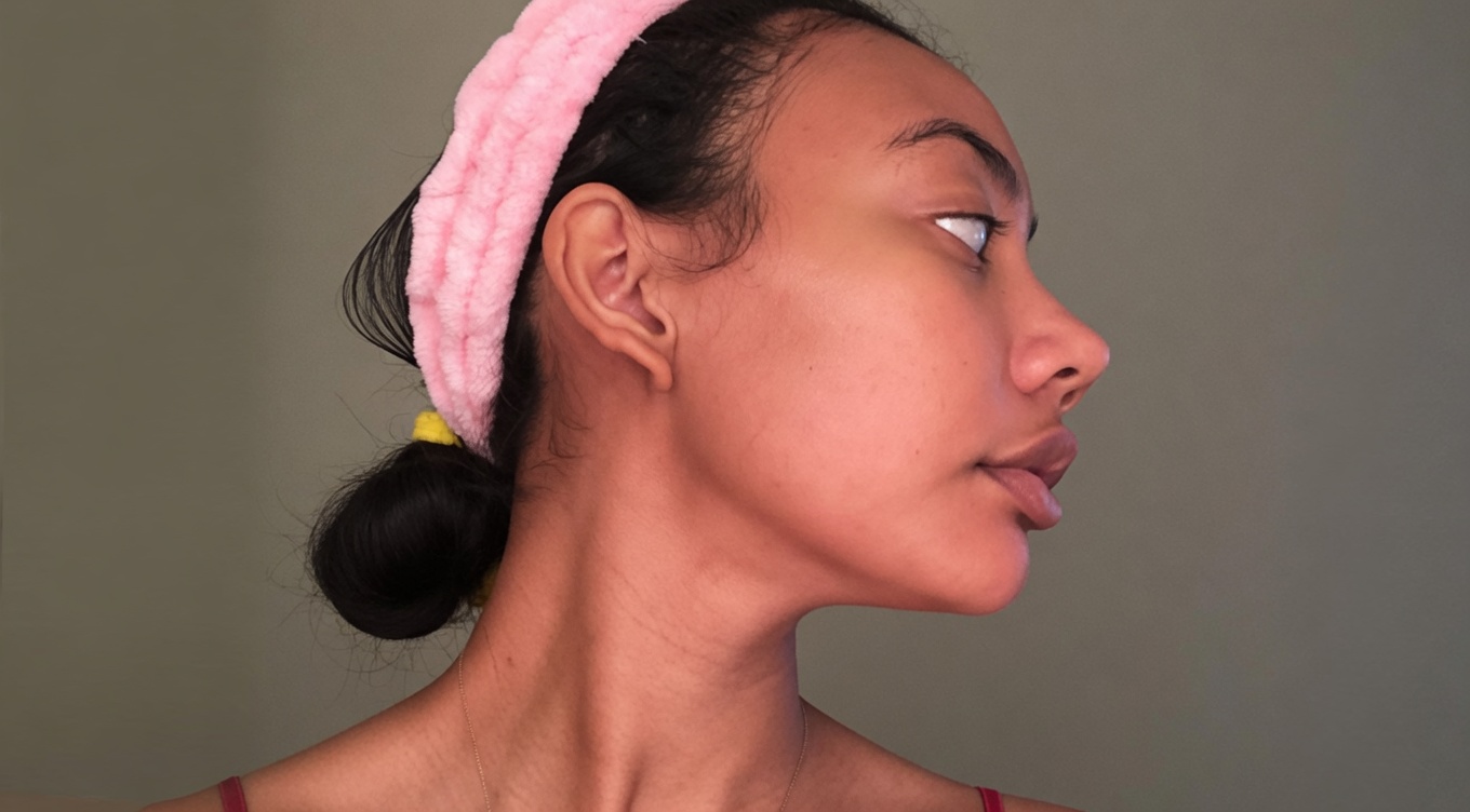 After — Acne & Blemishes