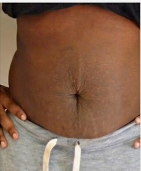 After — Stretch Marks