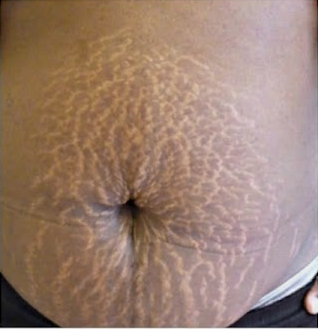 Before — Stretch Marks