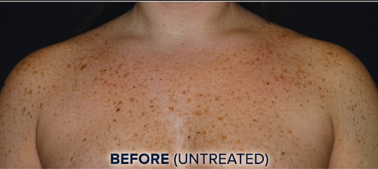 Before — Chest Hyperpigmentation